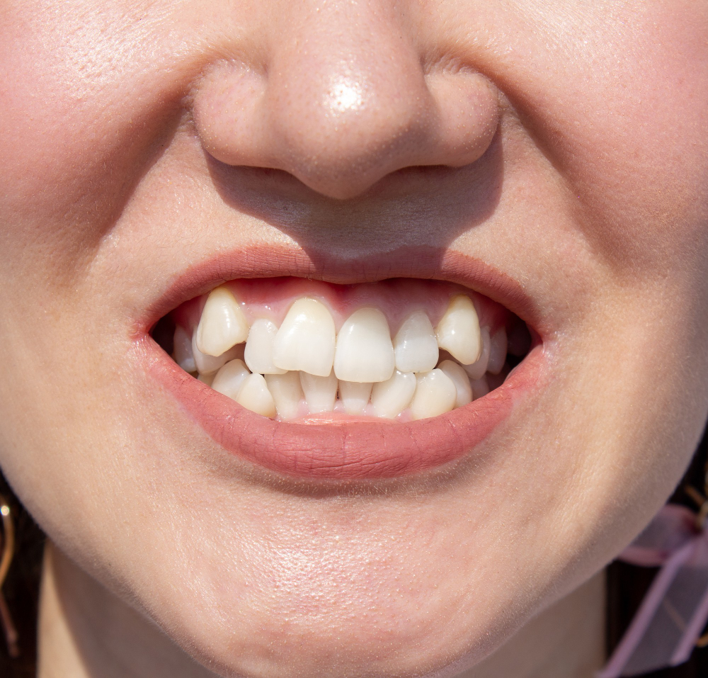prevenir apiñamiento dental