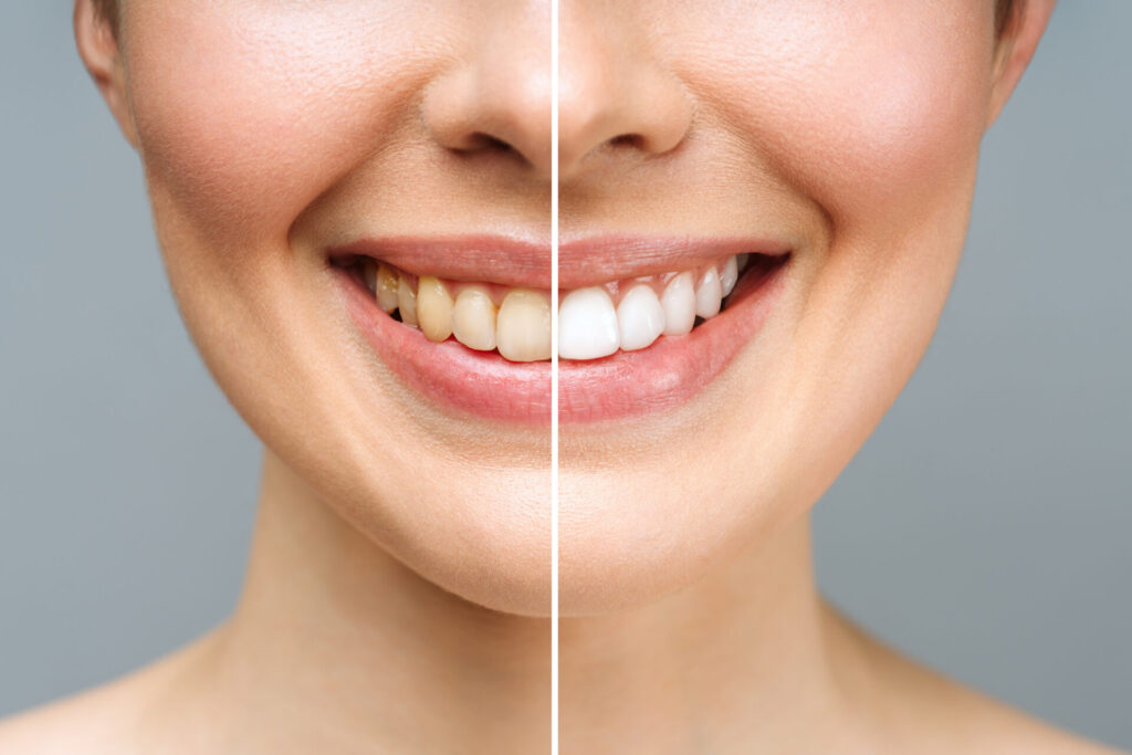 Blanquejament dental