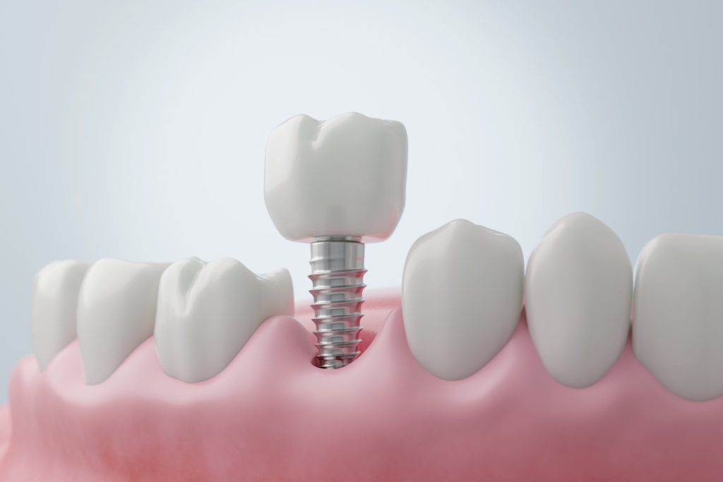 Il·lustració d'un implant dental