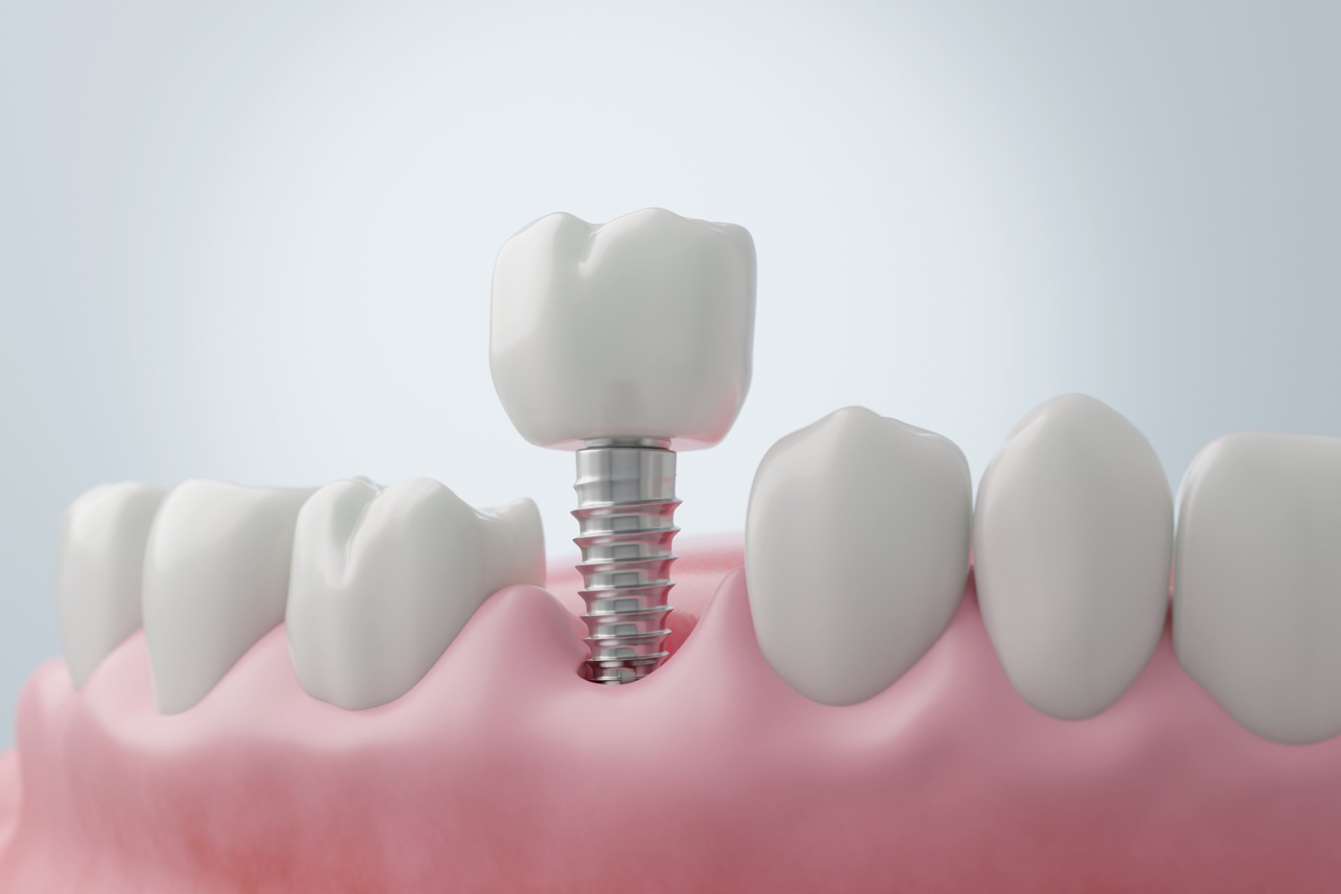 Il·lustració d'un implant dental