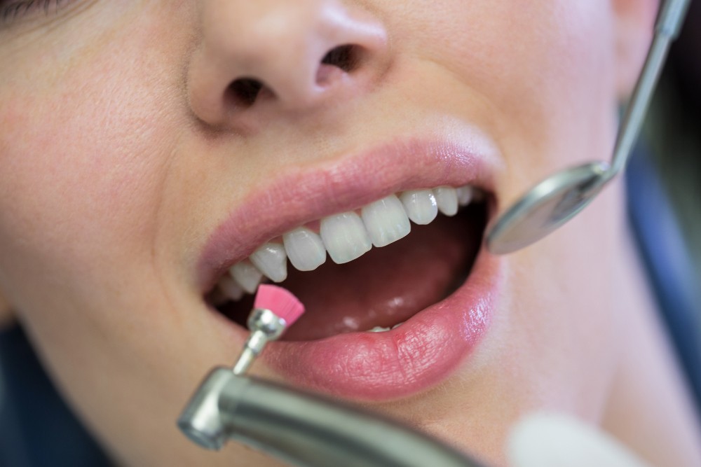 cuánto dura limpieza dental